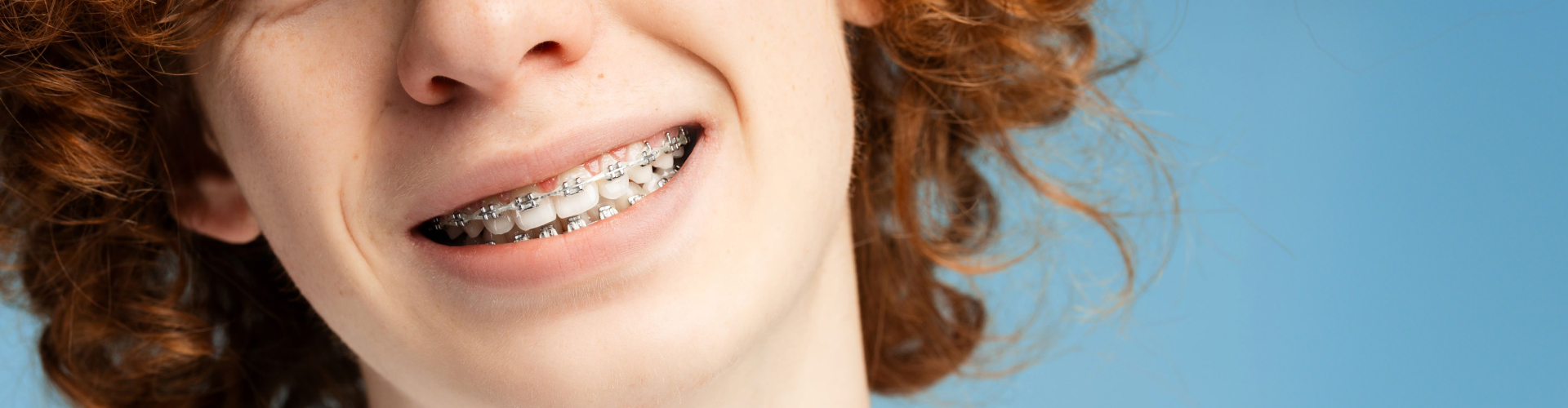 Close-up of a smiling patient wearing traditional metal dental braces for teeth alignment.